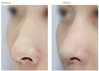 オープン鼻整形(鼻背+鼻先)、 鼻孔縁下降術の4ヵ月前後の症
