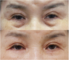 下眼瞼手術１ヶ月前後の症例写真