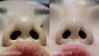 非開放鼻先手術+非切開小鼻縮小