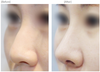 オープン鼻整形(鼻背+鼻中隔延長術)１ヶ月前後症例写真