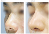 オープン鼻整形(鼻背+鼻先)3ヶ月前後の症例写真