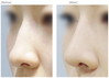オープン鼻整形(鼻背と鼻先)、わし鼻、曲がった鼻、長い鼻矯正