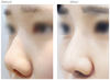 オープン鼻整形(鼻背と鼻先)　３ヶ月前後症例写真