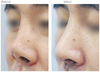 鼻再手術（拘縮や曲がった鼻矯正）３ヶ月 前後の症例写真