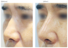  オープン鼻整形(わし鼻、鼻中隔延長術)3ヶ月前後の症例写真