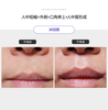 人中短縮＋外側＋口角挙上＋人中溝形成１か月目の症例写真