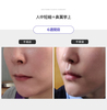 人中短縮＋鼻翼挙上術　６週間目　症例写真