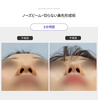 ノーズビーム　２か月目の症例写真